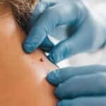 Moles Removal in Dubai: Create a Smoother and More Even-Looking Skin Appearance