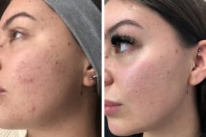 The Benefits of Medical Grade Skincare Before and After Procedures