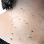 Skin Tag Removal in London: How Are Skin Tags in Sensitive Areas Evaluated?